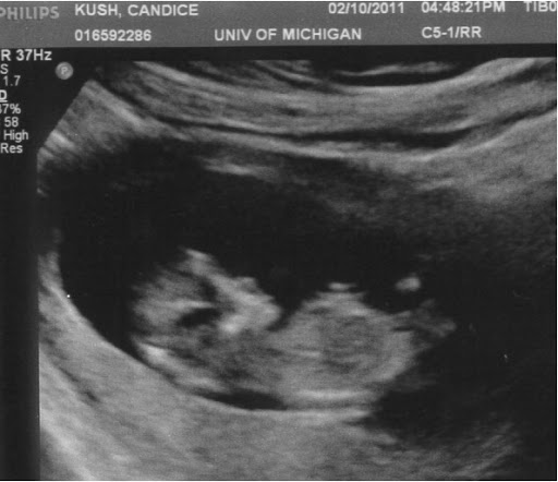13 weeks along