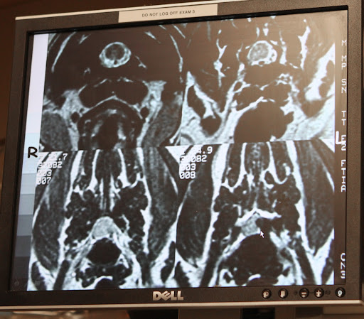 A cross section shows how the spine is being compressed.