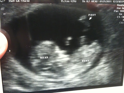 15 weeks along