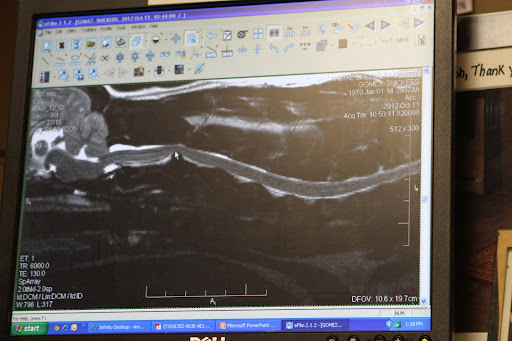 On this picture of another dog, the arrow is pointing to a similar bulging disc, which is compressing the spinal cord, causing great pain.