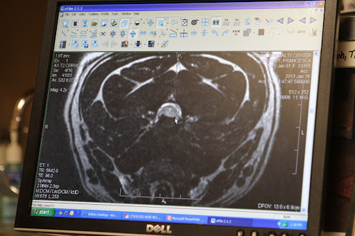 A bulging disc is a form of degenerative intervertebral disk disease. The bulging and related symptoms usually build up over time and eventually worsen because of the pressure on the spinal cord.